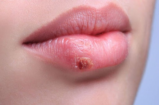 Nên xử lý những biến chứng gặp phải sau phun môi như thế nào?